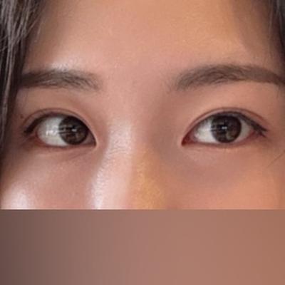 눈밑지방재배치 6주차, 눈밑 꺼짐 신경 하나도 안 쓰여요 사진 2 — 아바성형외과 눈밑지방재배치 후기