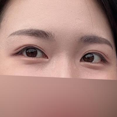 눈밑지방재배치 6주차, 눈밑 꺼짐 신경 하나도 안 쓰여요 사진 3 — 아바성형외과 눈밑지방재배치 후기