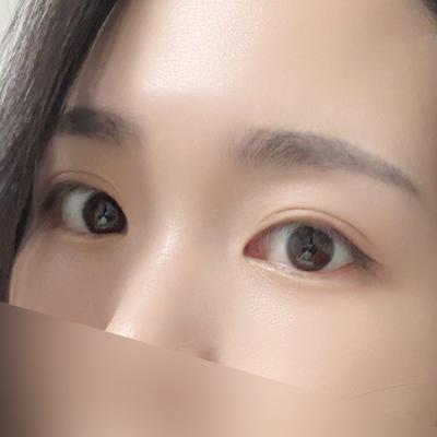 눈밑지방재배치 6주차, 눈밑 꺼짐 신경 하나도 안 쓰여요 사진 4 — 아바성형외과 눈밑지방재배치 후기