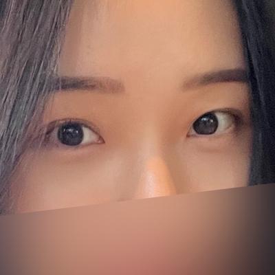 눈밑지방재배치 6주차, 감각도 돌아오고 퀭한 느낌 사라졌어요 — 아바성형외과 환자 후기 사진