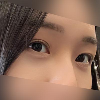 눈밑지방재배치 6주차, 감각도 돌아오고 퀭한 느낌 사라졌어요 사진 4 — 아바성형외과 눈밑지방재배치 후기