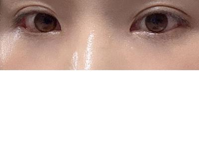 눈밑지방재배치 2주차, 다크서클 개선되고 눈도 또렷해졌어요 — 아바성형외과 환자 후기 사진