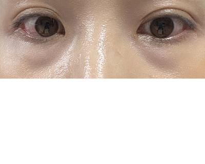 눈밑지방재배치 2주차, 다크서클 개선되고 눈도 또렷해졌어요 사진 2 — 아바성형외과 눈밑지방재배치 후기