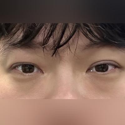 눈성형 2주차, 졸려 보이던 눈 해결돼서 너무 편해요 — 아바성형외과 환자 후기 사진