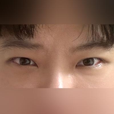 눈성형 2주차, 졸려 보이던 눈 해결돼서 너무 편해요 사진 2 — 아바성형외과 쌍꺼풀·눈성형 후기