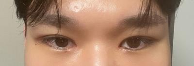 눈 수술 6주차, 눈이 적응되면서 훨씬 자연스러워졌어요 — 아바성형외과 환자 후기 사진