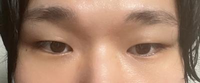 눈 수술 6주차, 눈이 적응되면서 훨씬 자연스러워졌어요 사진 2 — 아바성형외과 쌍꺼풀·눈성형 후기