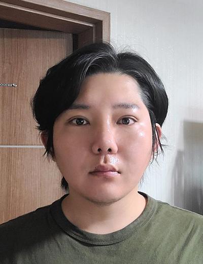 안검하수 절개 재수술 5주차, 눈 피곤함이 사라졌어요 — 아바성형외과 환자 후기 사진
