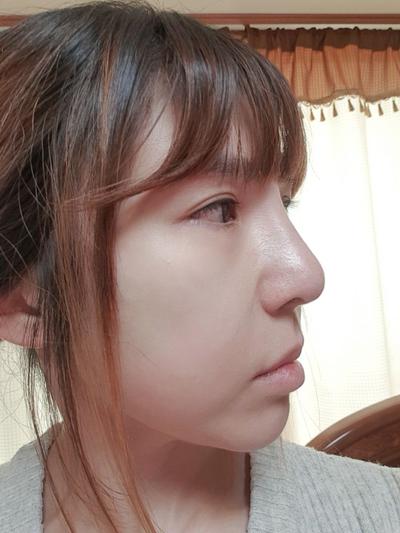 코재수술 후기, 발품 팔길 잘했어요 코끝 진짜 자연스러워요 사진 2 — 아바성형외과 코성형 후기