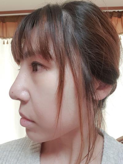 코재수술 후기, 발품 팔길 잘했어요 코끝 진짜 자연스러워요 사진 3 — 아바성형외과 코성형 후기