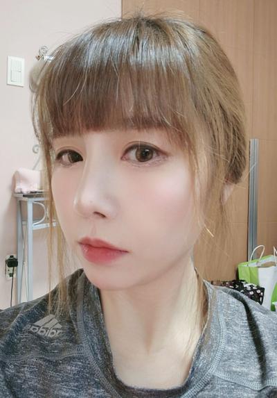 코재수술 후기, 발품 팔길 잘했어요 코끝 진짜 자연스러워요 사진 4 — 아바성형외과 코성형 후기