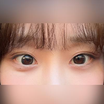 눈밑지방재배치 중안면거상 8주차, 인상 밝아졌대요 — 아바성형외과 환자 후기 사진