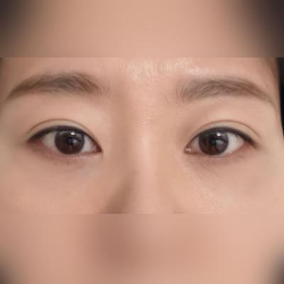 눈밑지방재배치＋자가지방이식 8주차, 눈밑 매끈해서 왜 늦게 했나 싶어요 — 아바성형외과 환자 후기 사진