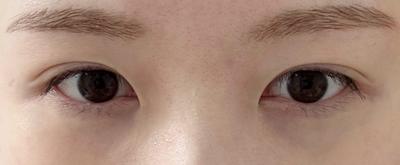 눈밑지방재배치 8주차, 화장하면 다크서클 커버 완전 잘돼요 — 아바성형외과 환자 후기 사진