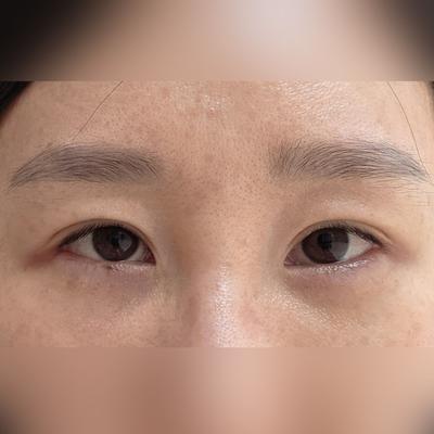 눈밑지방재배치 2주차, 볼록했던 눈밑이 싹 사라져서 신기해요 — 아바성형외과 환자 후기 사진