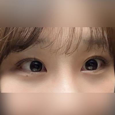 눈밑지방재배치 2주차, 눈밑 깔끔해지고 인상도 좋아졌어요 — 아바성형외과 환자 후기 사진