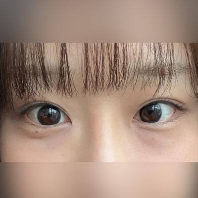 눈밑지방재배치 2주차, 눈밑 깔끔해지고 인상도 좋아졌어요 사진 2 — 아바성형외과 눈밑지방재배치 후기