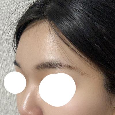 이마지방이식 8주차, 붓기 하나도 없고 진짜 티가 안 나요 — 아바성형외과 환자 후기 사진