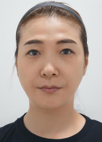 눈밑 꺼짐 고민하다 시술, 너무 잘돼서 마음에 쏙 들어요 사진 2 — 아바성형외과 눈밑지방재배치 후기