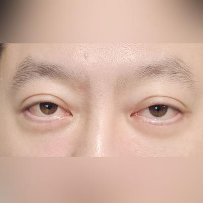 눈밑지방재배치 하안검 6주차, 젊어졌다는 말 들어요 — 아바성형외과 환자 후기 사진