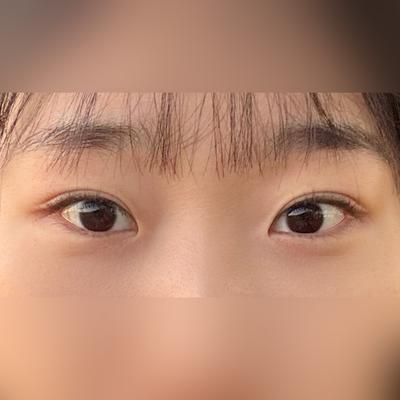 수술 6주차 후기, 부작용 없고 거울 볼수록 뿌듯해요 — 아바성형외과 환자 후기 사진