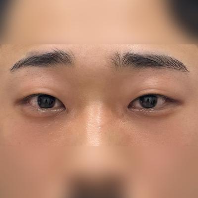 눈밑지방재배치 4주차, 어디서 했냐고 다들 물어봐요 — 아바성형외과 환자 후기 사진