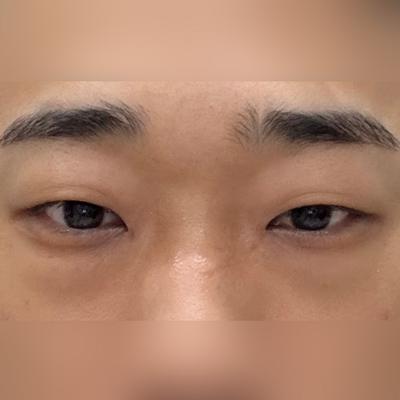 눈밑지방재배치 4주차, 어디서 했냐고 다들 물어봐요 사진 2 — 아바성형외과 눈밑지방재배치 후기