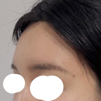 이마지방이식 2주차, 10일 지나니 원하던 모양 나와요 사진 4 — 아바성형외과 이마거상 후기