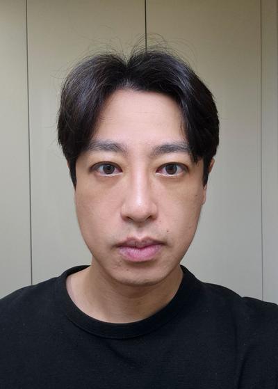 눈밑지방재배치 눈매교정 2주차, 통증도 없고 피곤한 인상 사라졌어요 — 아바성형외과 환자 후기 사진