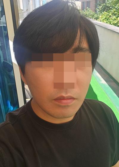 리프팅 6주차, 붓기 다 빠지고 젊어졌다는 말 들어요 — 아바성형외과 환자 후기 사진