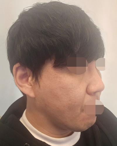 리프팅 6주차, 붓기 다 빠지고 젊어졌다는 말 들어요 사진 2 — 아바성형외과 리프팅·쁘띠 후기