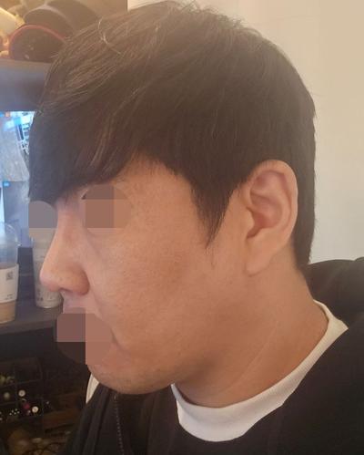 리프팅 6주차, 붓기 다 빠지고 젊어졌다는 말 들어요 사진 4 — 아바성형외과 리프팅·쁘띠 후기