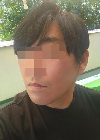 리프팅 6주차, 붓기 다 빠지고 젊어졌다는 말 들어요 사진 5 — 아바성형외과 리프팅·쁘띠 후기