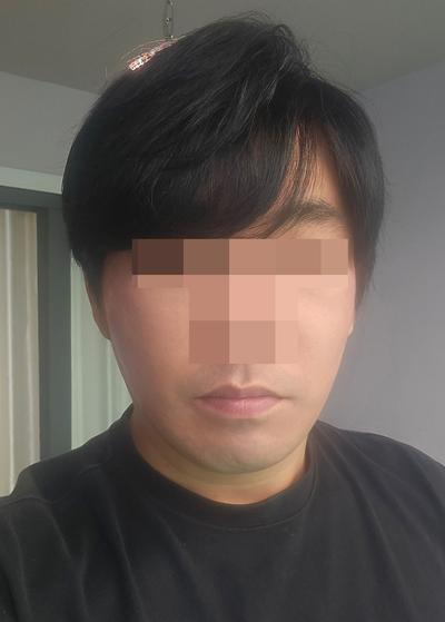 리프팅 6주차, 붓기 다 빠지고 젊어졌다는 말 들어요 사진 6 — 아바성형외과 리프팅·쁘띠 후기