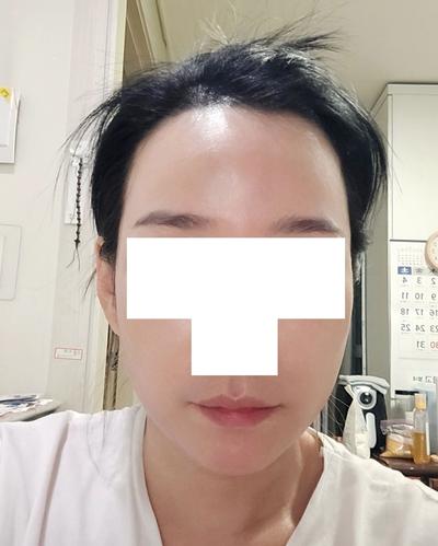 50대 아큐 거상에 이마필러까지, 30대로 돌아왔대요 — 아바성형외과 환자 후기 사진