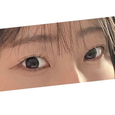 눈밑지방재배치 6주차, 민낯인데도 화사해서 대만족이에요 사진 4 — 아바성형외과 눈밑지방재배치 후기