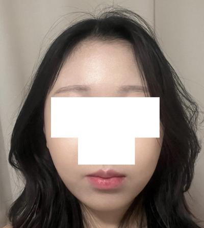 김승수 원장님께 수술받고 9주차, 잔붓기 빼면 대만족이에요 — 아바성형외과 환자 후기 사진