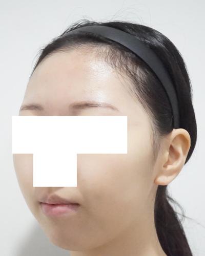 김승수 원장님께 수술받고 9주차, 잔붓기 빼면 대만족이에요 사진 3 — 아바성형외과 기타 후기