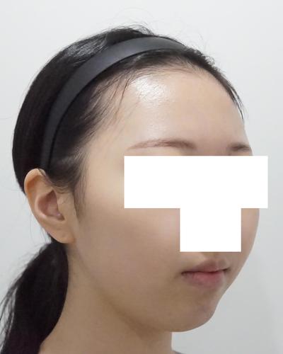김승수 원장님께 수술받고 9주차, 잔붓기 빼면 대만족이에요 사진 4 — 아바성형외과 기타 후기