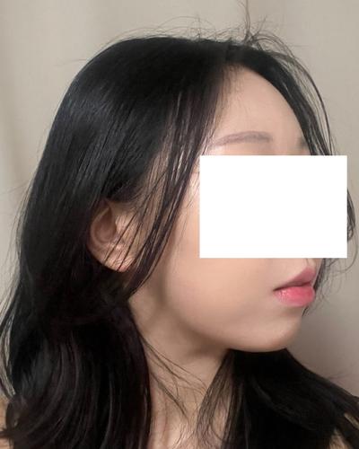 김승수 원장님께 수술받고 9주차, 잔붓기 빼면 대만족이에요 사진 5 — 아바성형외과 기타 후기