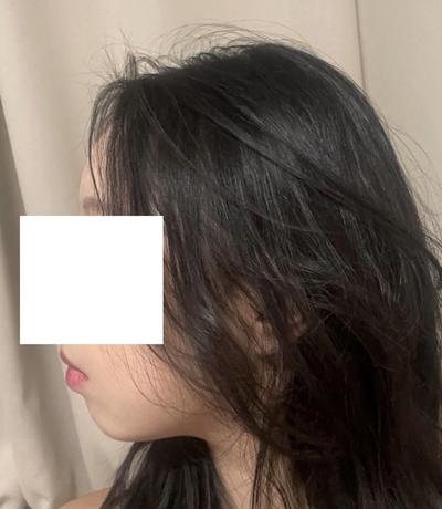 김승수 원장님께 수술받고 9주차, 잔붓기 빼면 대만족이에요 사진 6 — 아바성형외과 기타 후기