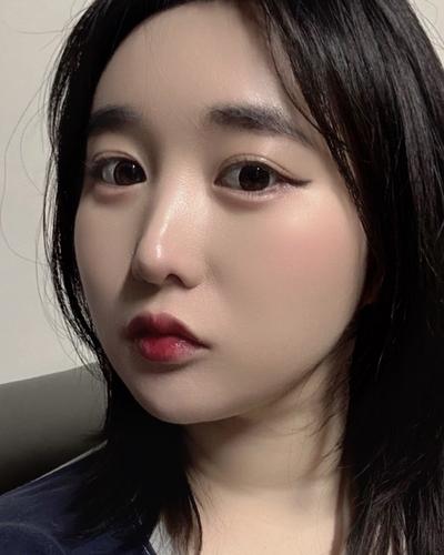 이마·관자놀이 지방이식 후기, 볼륨 자연스럽게 잡혔어요 — 아바성형외과 환자 후기 사진