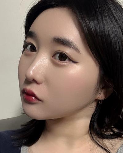 이마·관자놀이 지방이식 후기, 볼륨 자연스럽게 잡혔어요 사진 4 — 아바성형외과 이마거상 후기