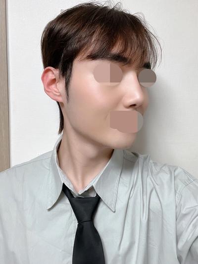 본문 없이 안내 문구만 남겨진 후기입니다 — 아바성형외과 환자 후기 사진