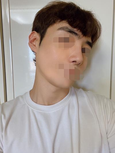 코성형 후기, 휘어 있던 코끝 완벽하게 고쳐주셨어요 — 아바성형외과 환자 후기 사진