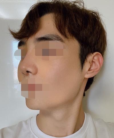 코성형 후기, 휘어 있던 코끝 완벽하게 고쳐주셨어요 사진 4 — 아바성형외과 코성형 후기