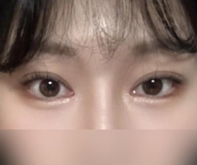 눈 수술 3개월차, 화장 안 해도 눈이 시원해 보여요 — 아바성형외과 환자 후기 사진