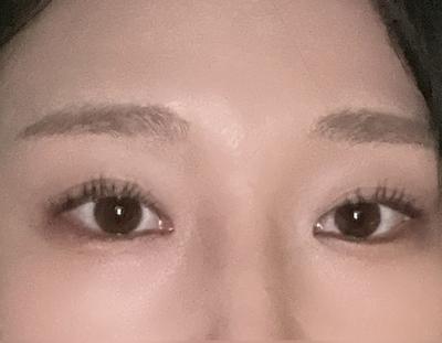 눈 수술 3개월차, 화장 안 해도 눈이 시원해 보여요 사진 2 — 아바성형외과 쌍꺼풀·눈성형 후기