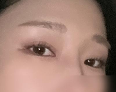 눈 수술 3개월차, 화장 안 해도 눈이 시원해 보여요 사진 3 — 아바성형외과 쌍꺼풀·눈성형 후기