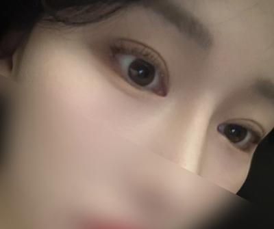 눈 수술 3개월차, 화장 안 해도 눈이 시원해 보여요 사진 4 — 아바성형외과 쌍꺼풀·눈성형 후기